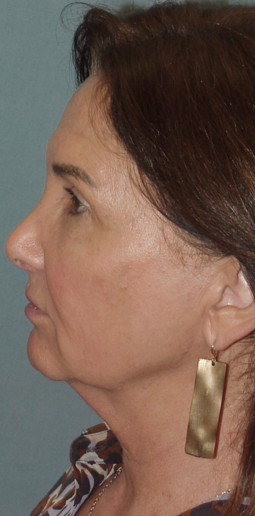 Photo of the patient’s face before the Facelift surgery. Set 3. Patient 7