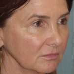 Thumbnail photo of the patient’s before the Facelift Patient 7