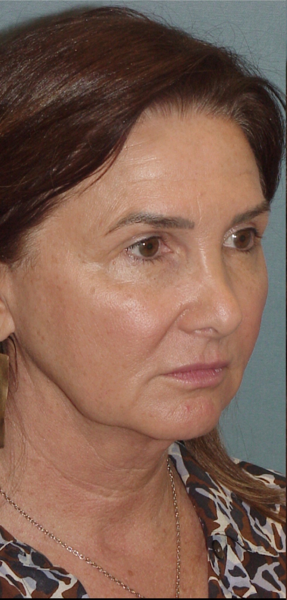Photo of the patient’s face before the Facelift surgery. Set 2. Patient 7
