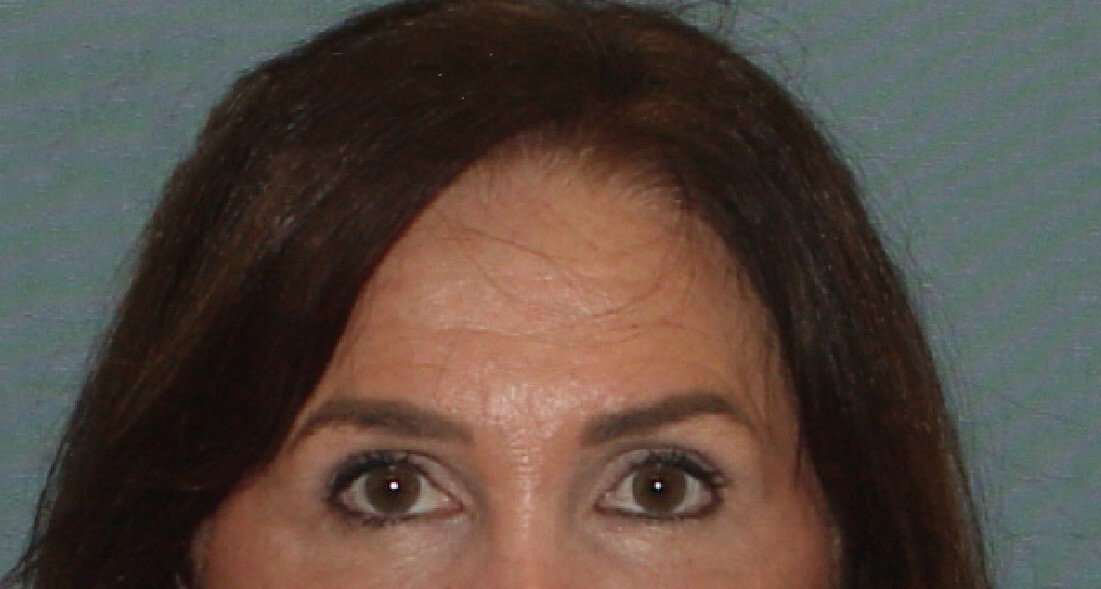 Photo of the patient’s after the Browlift Patient 1