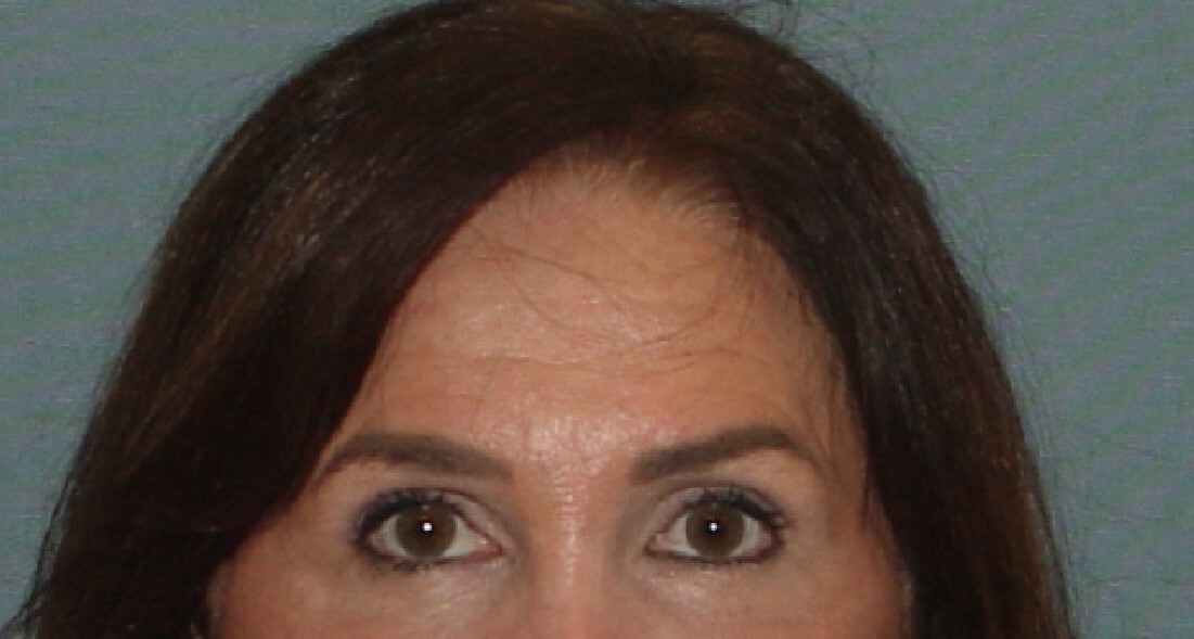 Photo of the patient’s face after the Browlift surgery. Set 1. Patient 1