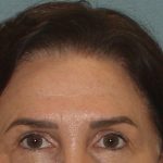 Thumbnail photo of the patient’s before the Browlift Patient 1