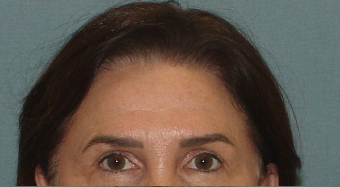 Photo of the patient’s face before the Browlift surgery. Set 1. Patient 1