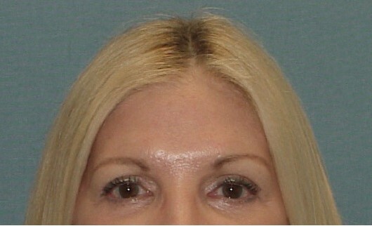 Photo of the patient’s face after the Browlift surgery. Set 1. Patient 2
