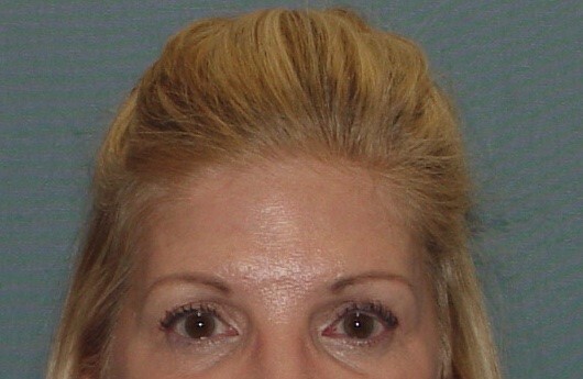 Photo of the patient’s face before the Browlift surgery. Set 1. Patient 2
