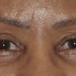 Thumbnail photo of the patient’s after the Eyelid Surgery Patient 1