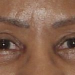 Photo of the patient’s face after the Eyelid surgery. Set 1. Patient 1