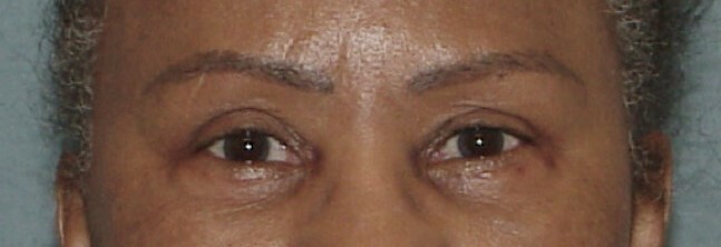 Photo of the patient’s face after the Eyelid surgery. Set 1. Patient 1