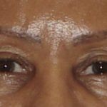 Photo of the patient’s face before the Eyelid surgery. Set 1. Patient 1
