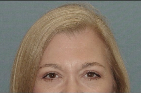 Photo of the patient’s face after the Eyelid surgery. Set 1. Patient 2