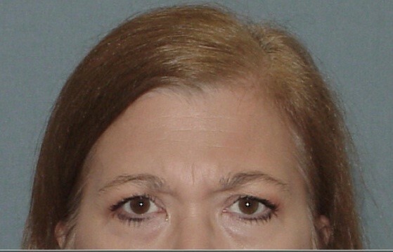 Photo of the patient’s face before the Eyelid surgery. Set 1. Patient 2