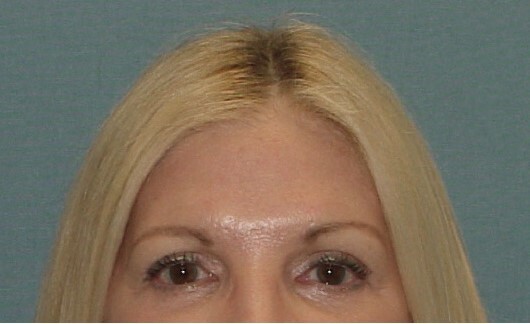 Photo of the patient’s face after the Eyelid surgery. Set 1. Patient 3