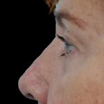Thumbnail photo of the patient’s after the Rhinoplasty Patient 22
