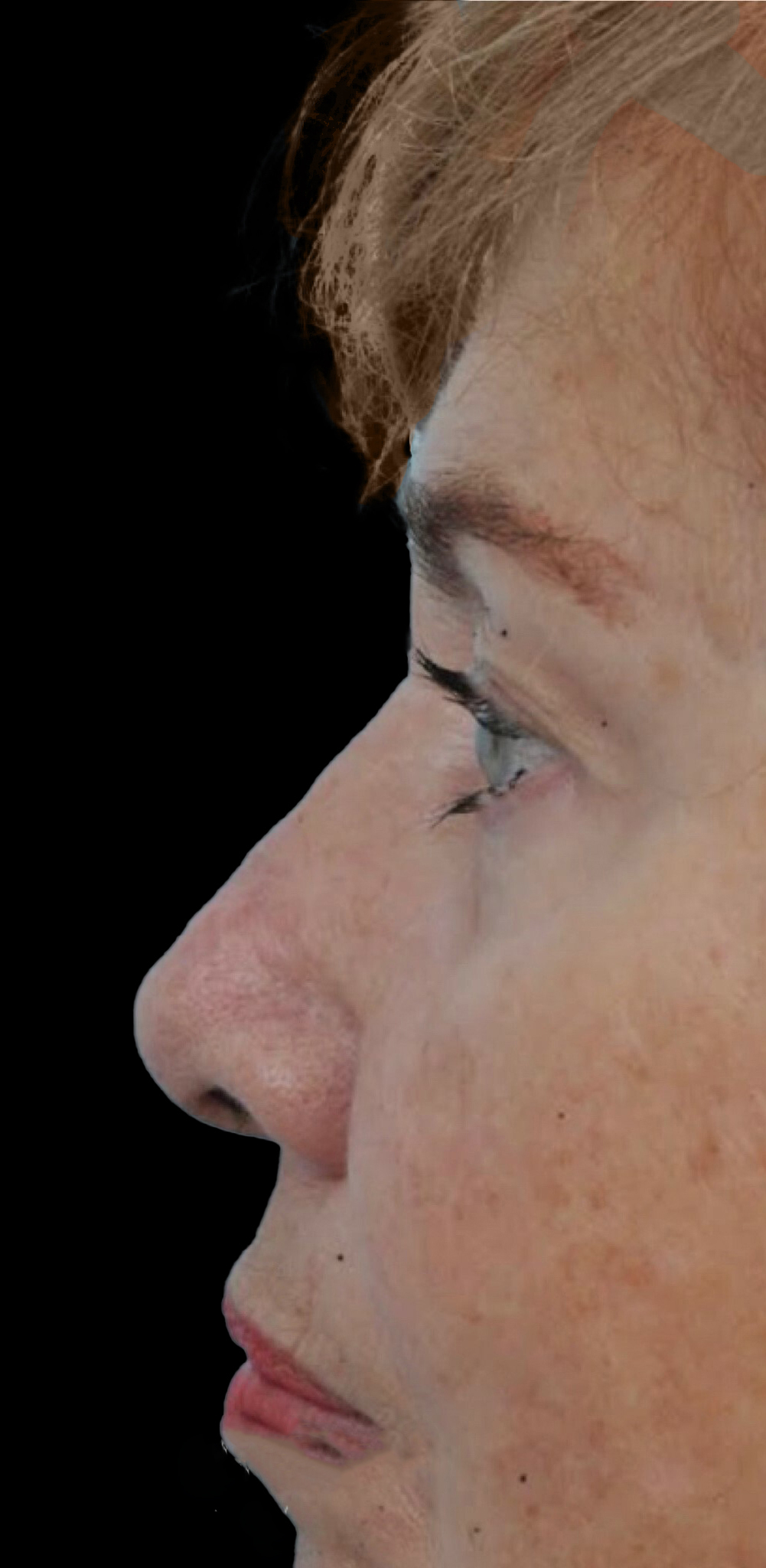 Photo of the patient’s after the Rhinoplasty Patient 22