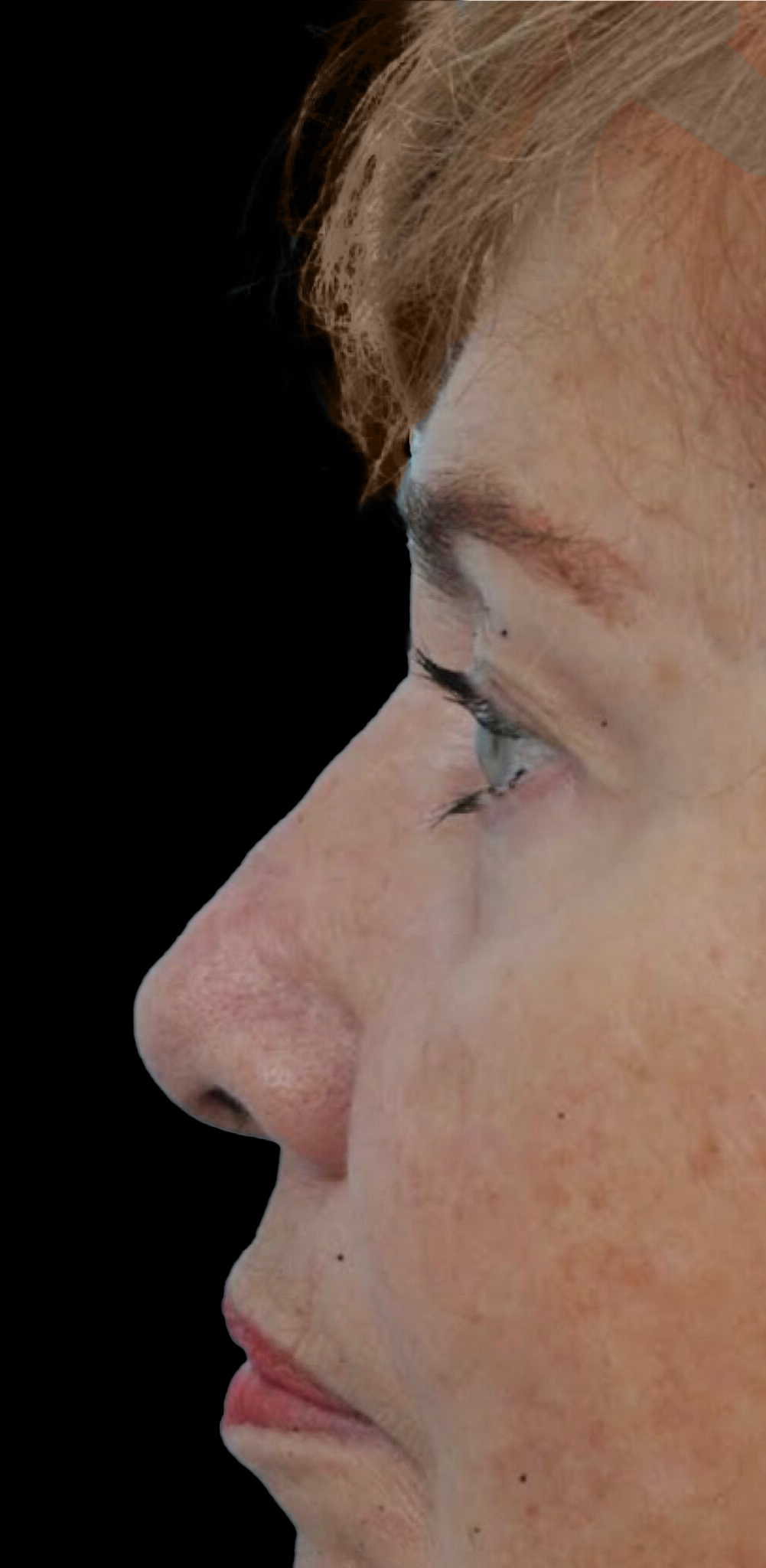 Photo of the patient’s face after the Rhinoplasty surgery. Patient 22 - Set 2