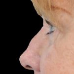 Thumbnail photo of the patient’s before the Rhinoplasty Patient 22