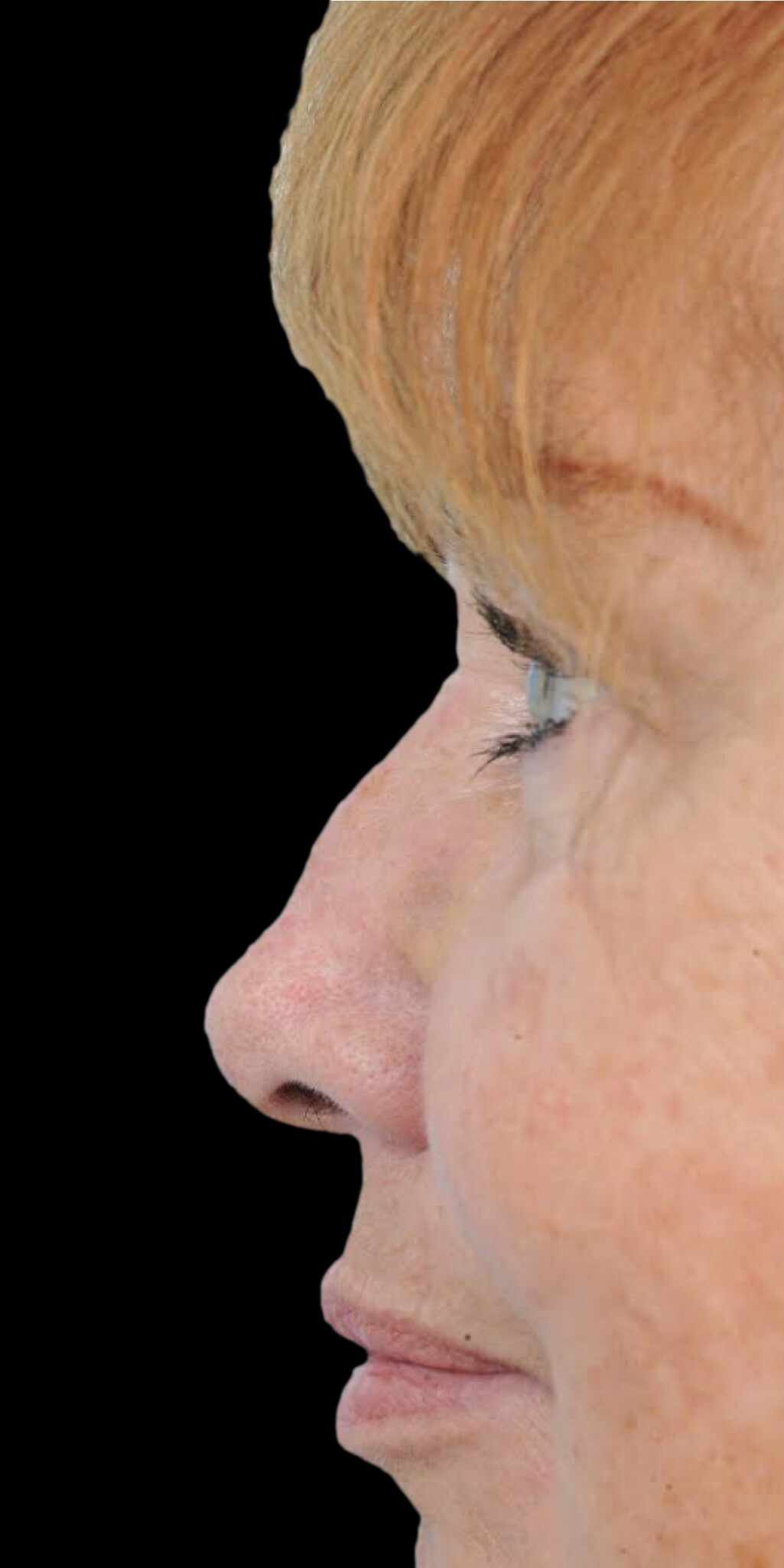 Photo of the patient’s before the Rhinoplasty Patient 22