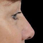 Thumbnail photo of the patient’s after the Rhinoplasty Patient 22