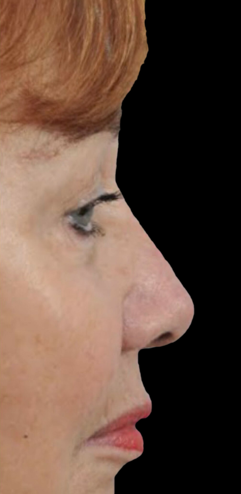 Photo of the patient’s face after the Rhinoplasty surgery. Patient 22 - Set 1