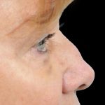 Thumbnail photo of the patient’s before the Rhinoplasty Patient 22