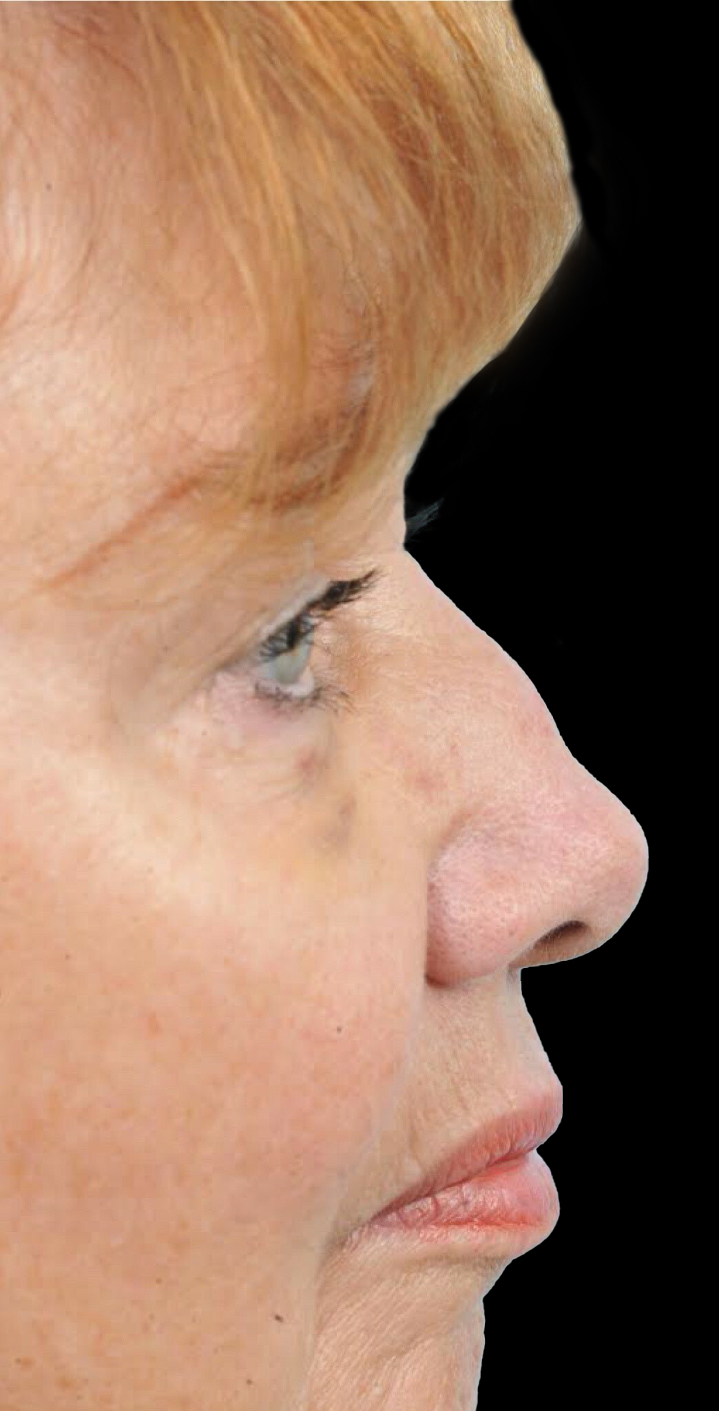 Photo of the patient’s face before the Rhinoplasty surgery. Patient 22 - Set 1