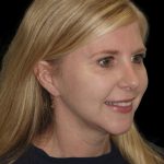 Thumbnail photo of the patient’s after the Rhinoplasty Patient 23