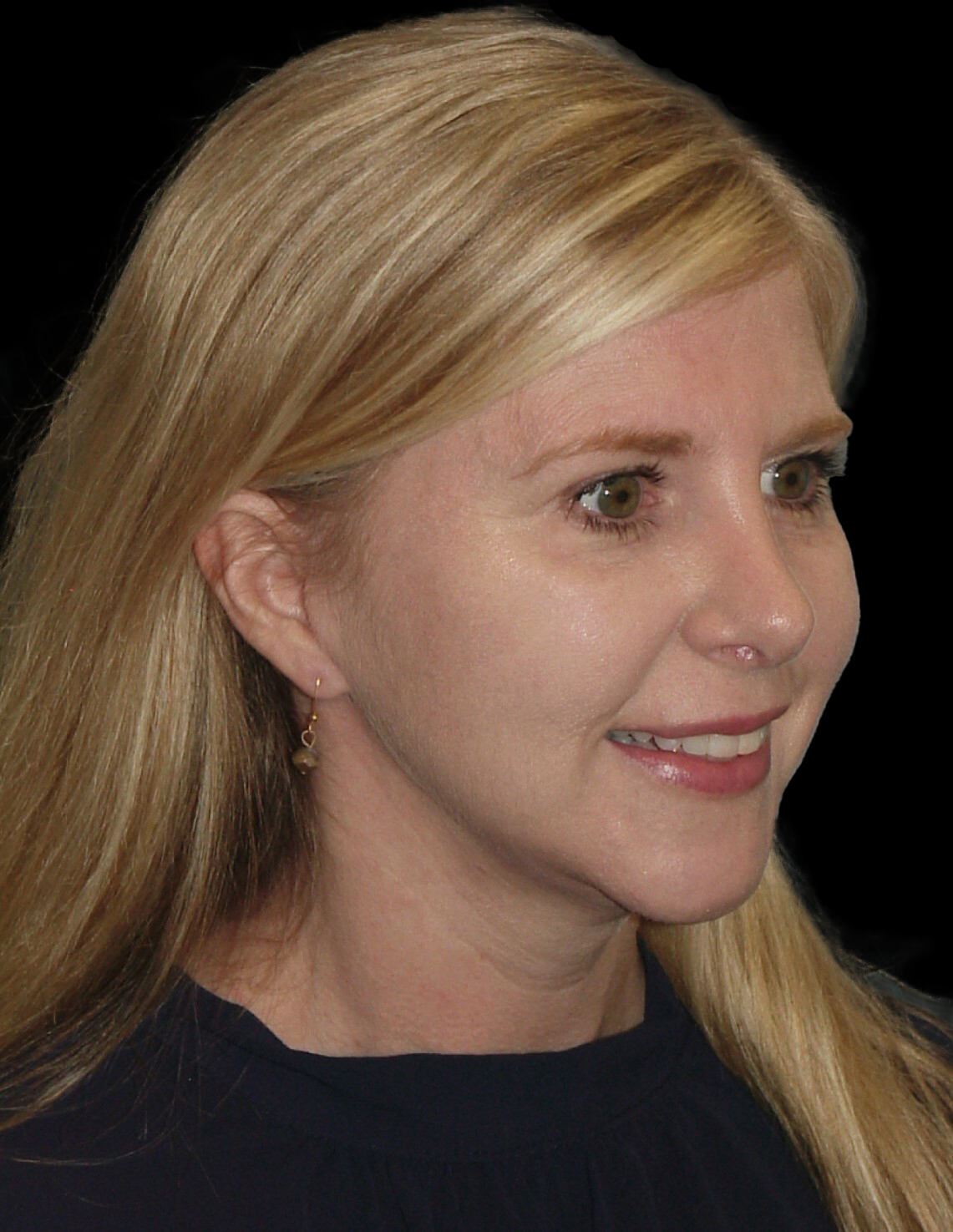 Photo of the patient’s after the Rhinoplasty Patient 23