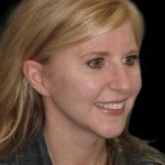 Thumbnail photo of the patient’s before the Rhinoplasty Patient 23