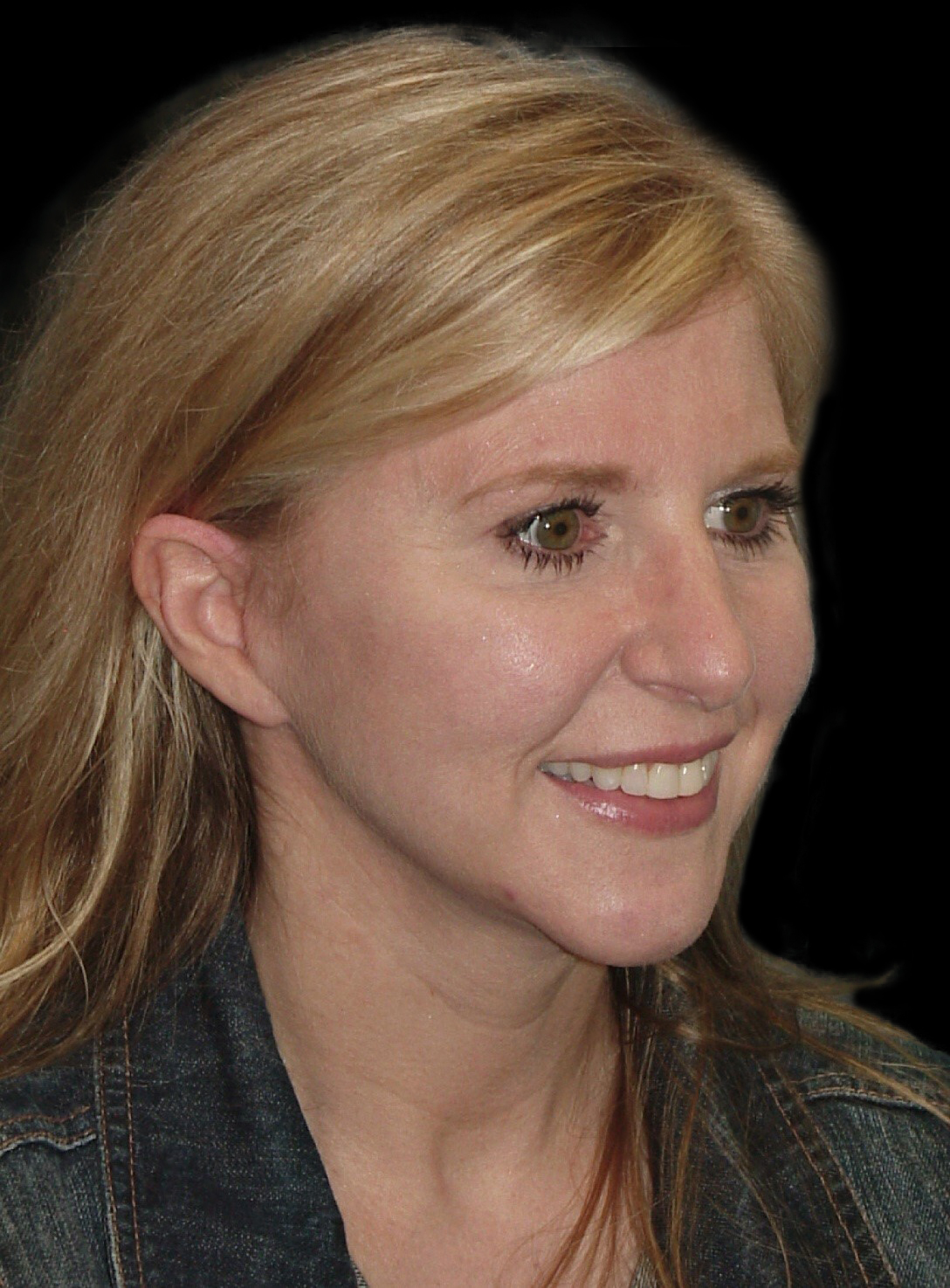 Photo of the patient’s before the Rhinoplasty Patient 23