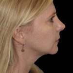 Thumbnail photo of the patient’s after the Rhinoplasty Patient 23