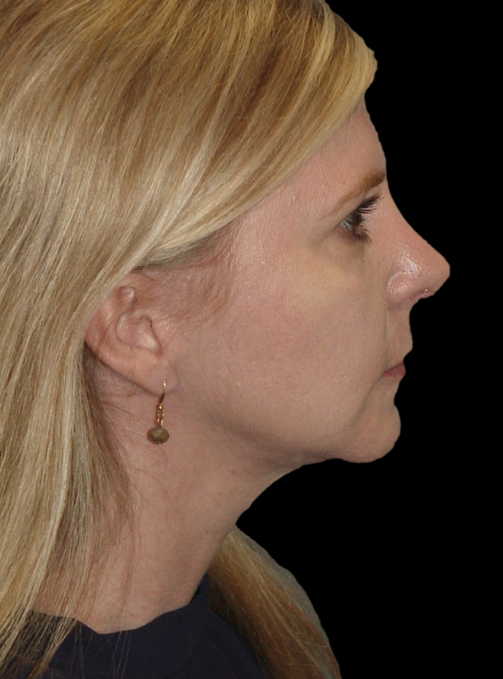 Photo of the patient’s after the Rhinoplasty Patient 23
