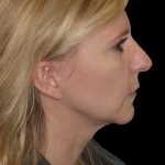 Photo of the patient’s face before the Rhinoplasty surgery. Patient 23 - Set 1