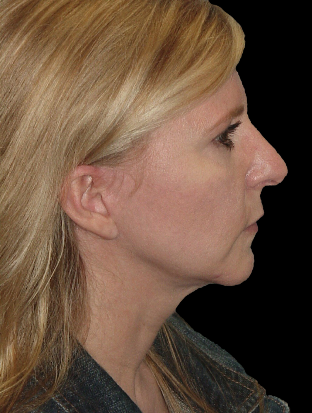 Photo of the patient’s face before the Rhinoplasty surgery. Patient 23 - Set 1