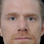 Thumbnail photo of the patient’s after the Rhinoplasty Patient 24