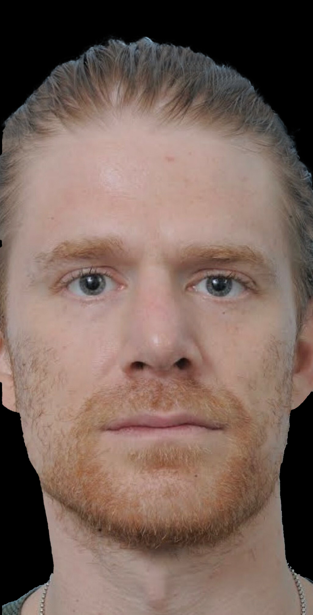 Photo of the patient’s after the Rhinoplasty Patient 24