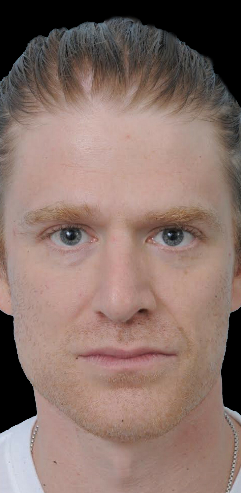 Photo of the patient’s before the Rhinoplasty Patient 24