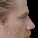 Thumbnail photo of the patient’s after the Rhinoplasty Patient 24