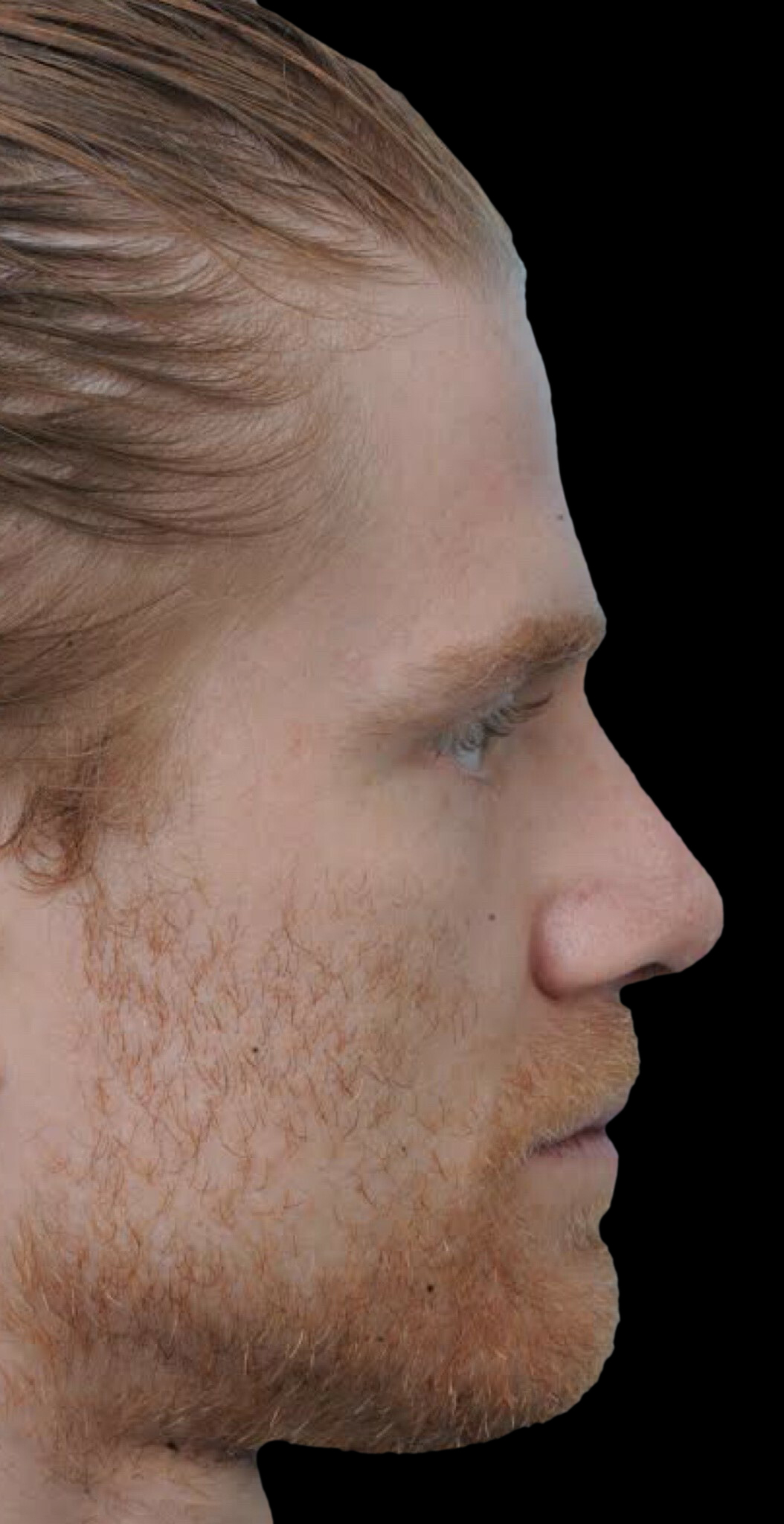 Photo of the patient’s after the Rhinoplasty Patient 24