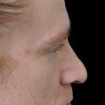 Thumbnail photo of the patient’s before the Rhinoplasty Patient 24