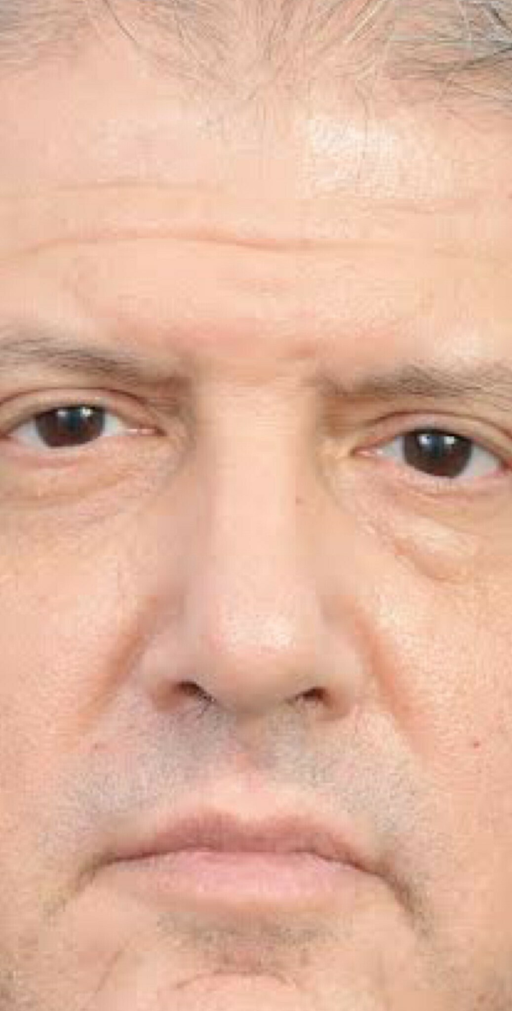 Photo of the patient’s face after the Rhinoplasty surgery. Patient 25 - Set 1
