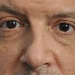 Thumbnail photo of the patient’s before the Rhinoplasty Patient 25