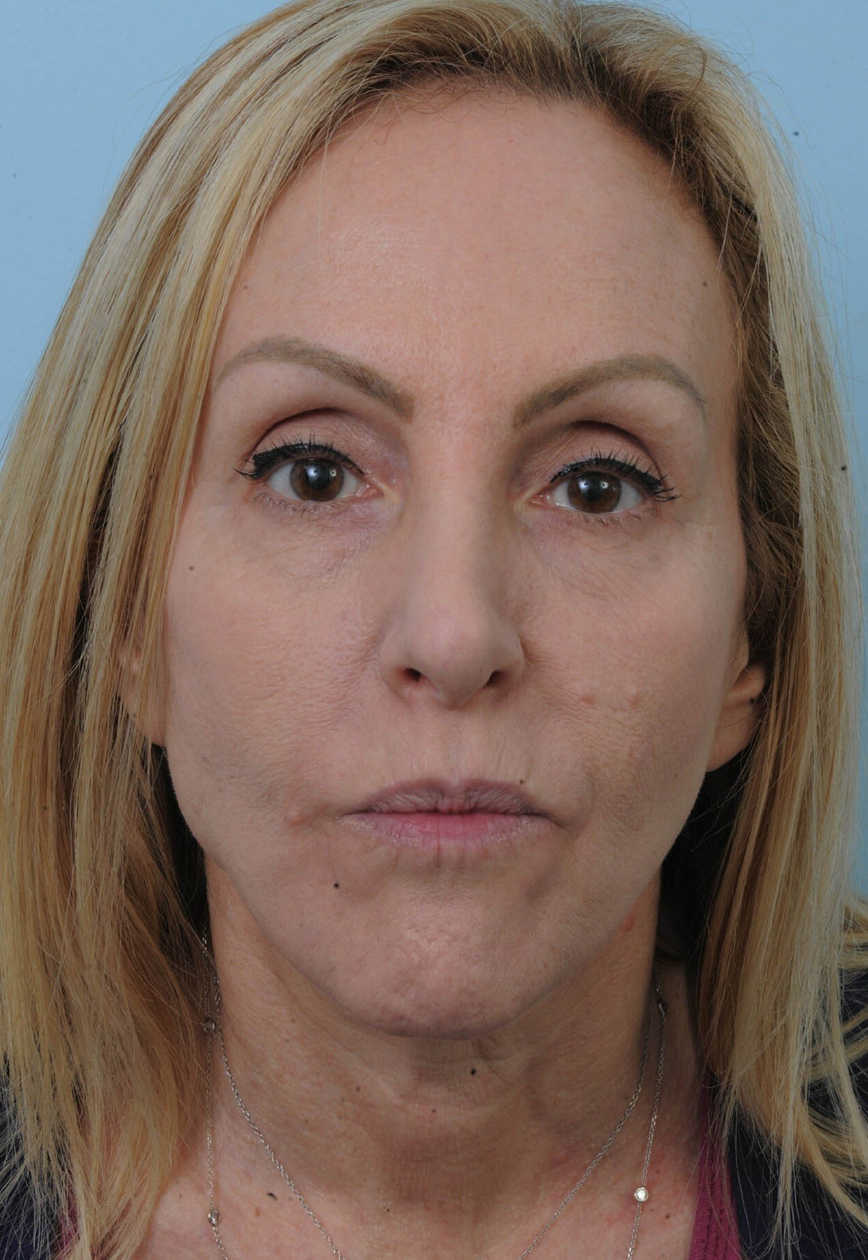 Photo of the patient’s face before the Facelift surgery. Set 1. Patient 6