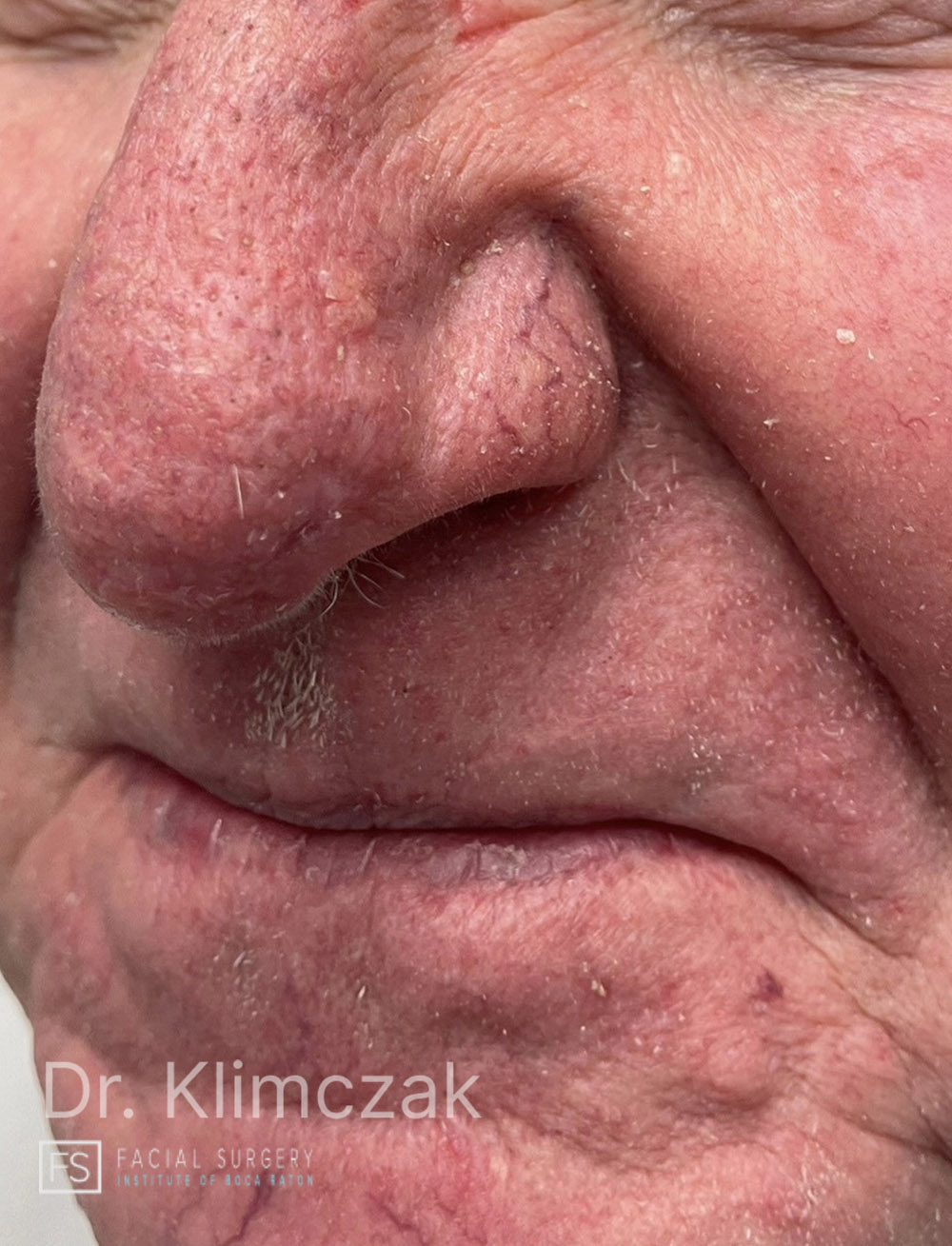 Photo of the patient’s after the Skin Cancer Reconstruction Patient 1