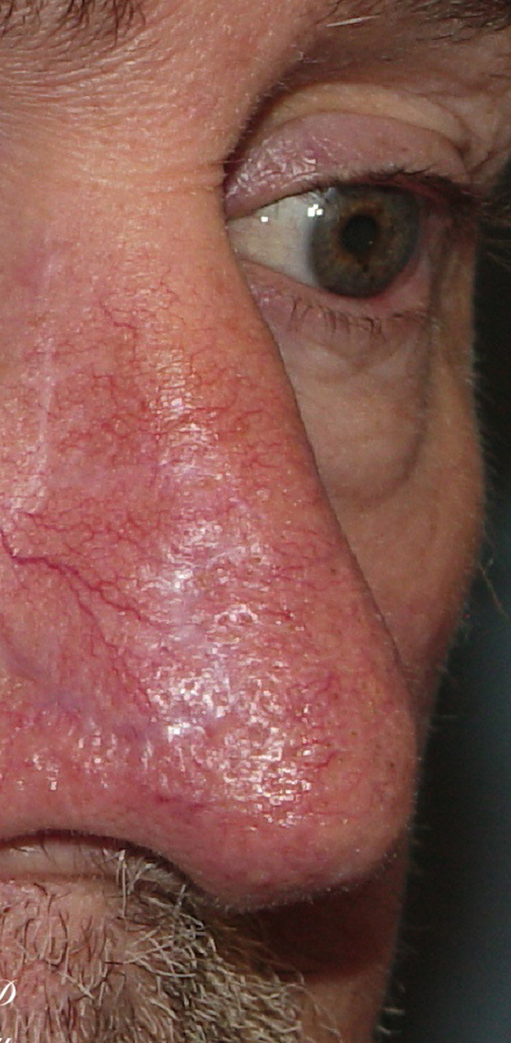 Photo of the patient’s after the Skin Cancer Reconstruction Patient 10