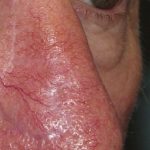 Thumbnail photo of the patient’s after the Skin Cancer Reconstruction Patient 10