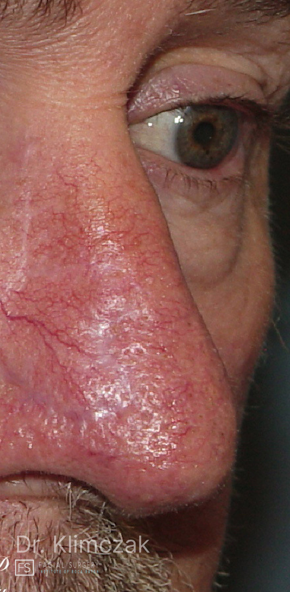 Photo of the patient’s after the Skin Cancer Reconstruction Patient 10