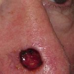 Thumbnail photo of the patient’s before the Skin Cancer Reconstruction Patient 10