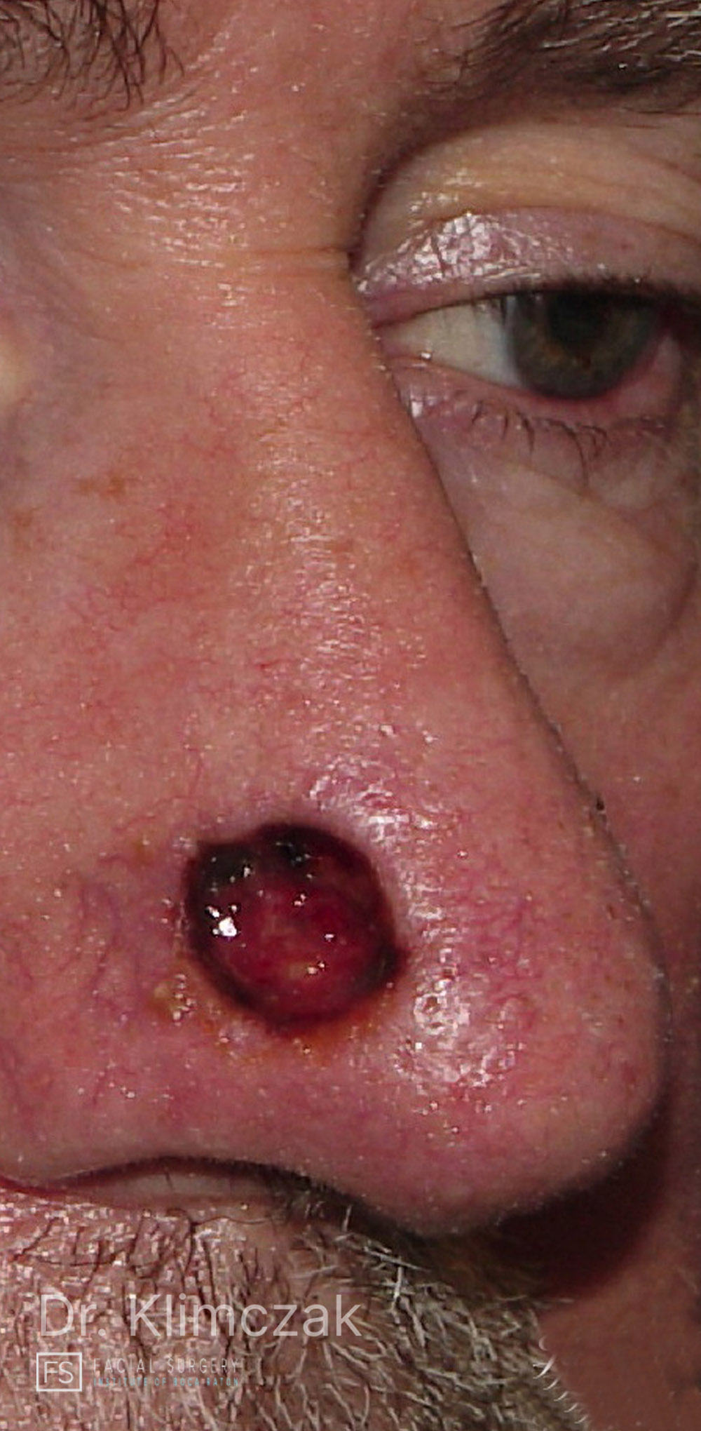 Photo of the patient’s before the Skin Cancer Reconstruction Patient 10