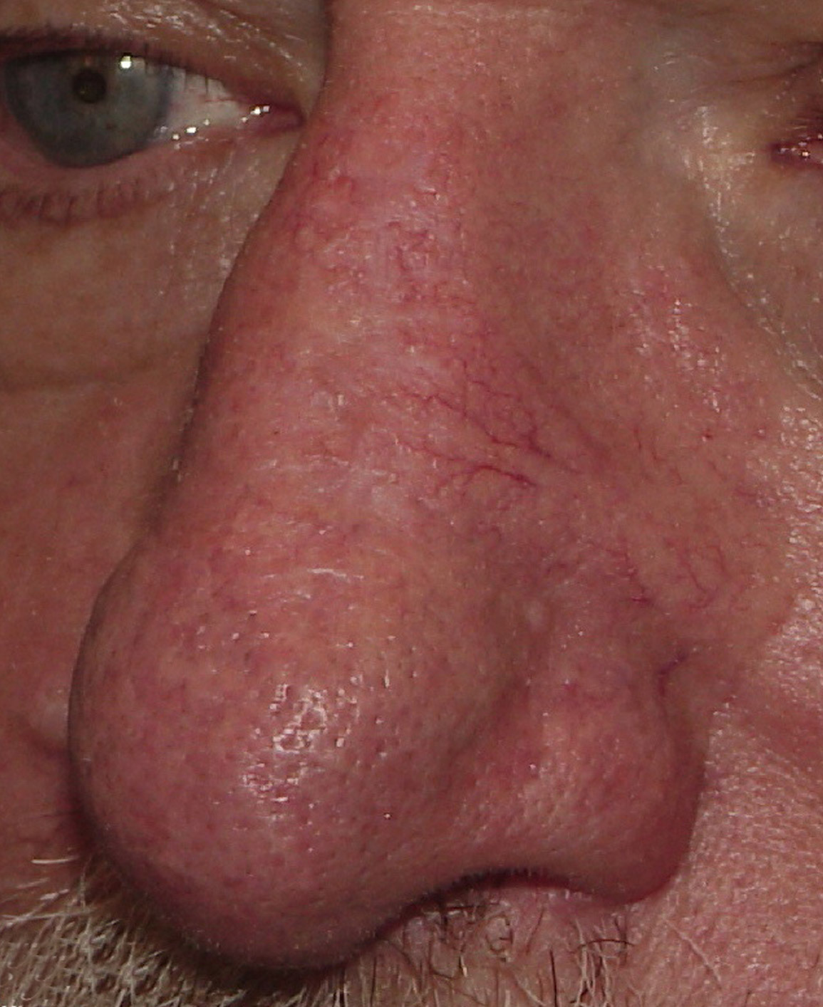 Photo of the patient’s after the Skin Cancer Reconstruction Patient 11