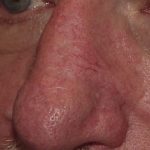 Thumbnail photo of the patient’s after the Skin Cancer Reconstruction Patient 11